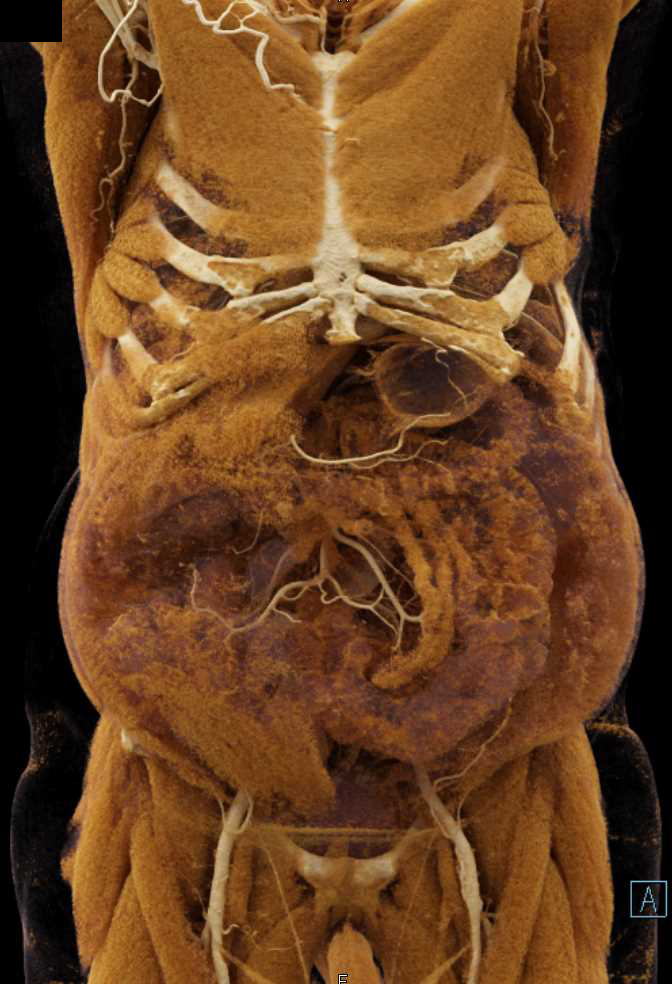 Abdominal Aortic Aneurysm with Cinematic Rendering - CTisus CT Scan