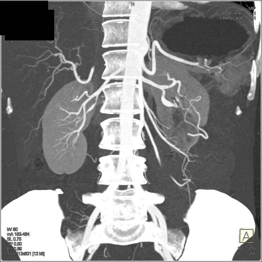 Vasculitis Involving the Renal Arteries - CTisus CT Scan