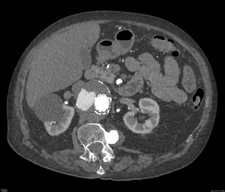 Type 2 Endovascular Leak - CTisus CT Scan