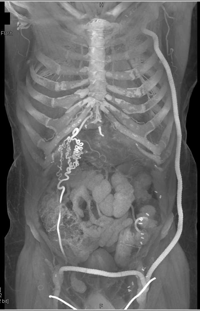 Fem-Fem Graft and Collaterals Right Abdominal Wall with Cinematic Rendering - CTisus CT Scan