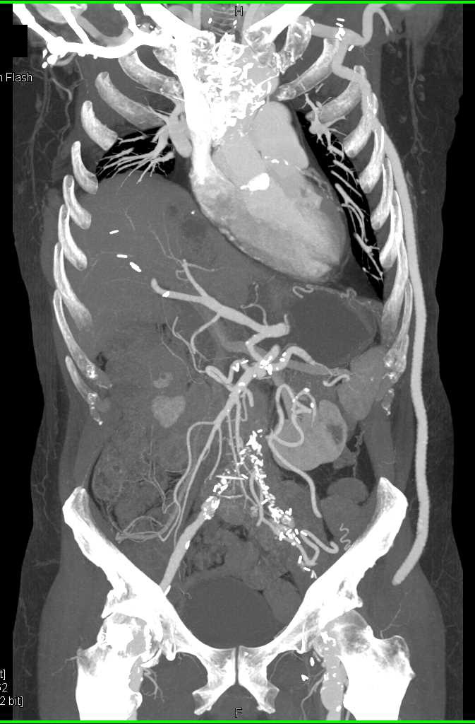 Fem-Fem Graft and Left Axillary to Femoral Artery Bypass Graft and Collaterals Right Abdominal Wall with Cinematic Rendering - CTisus CT Scan