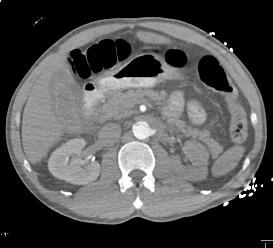 Aortic Dissection with Bleed - CTisus CT Scan