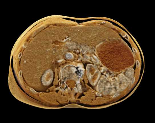 Cinematic Rendering of the Mesenteric Arcade - CTisus CT Scan