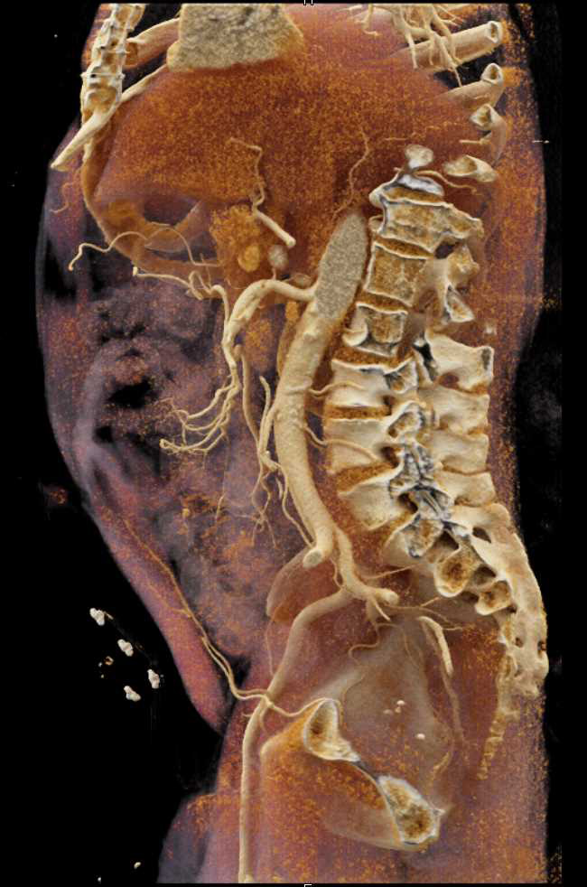 Cinematic Rendering of the Mesenteric Arcade - CTisus CT Scan