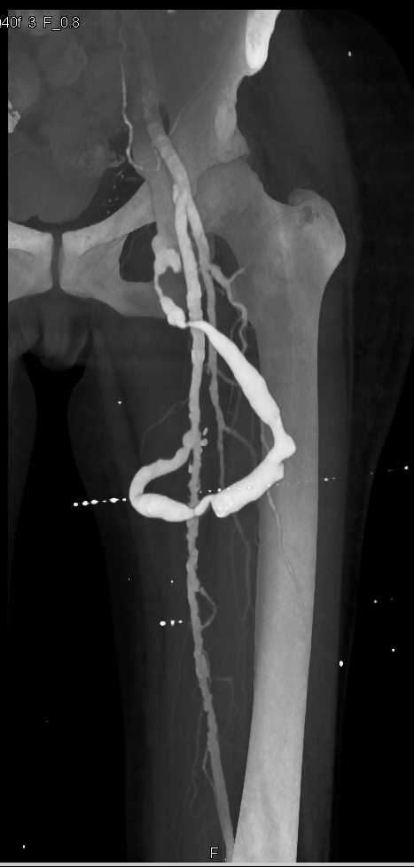 Peripheral Vascular Disease (PVD) with AV Fistulae - CTisus CT Scan