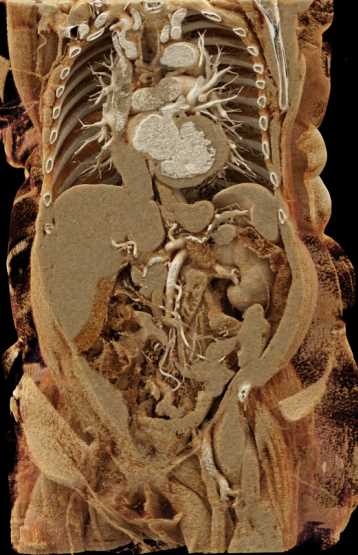 Vasculitis Involves that the Mesenteric Vessels - CTisus CT Scan