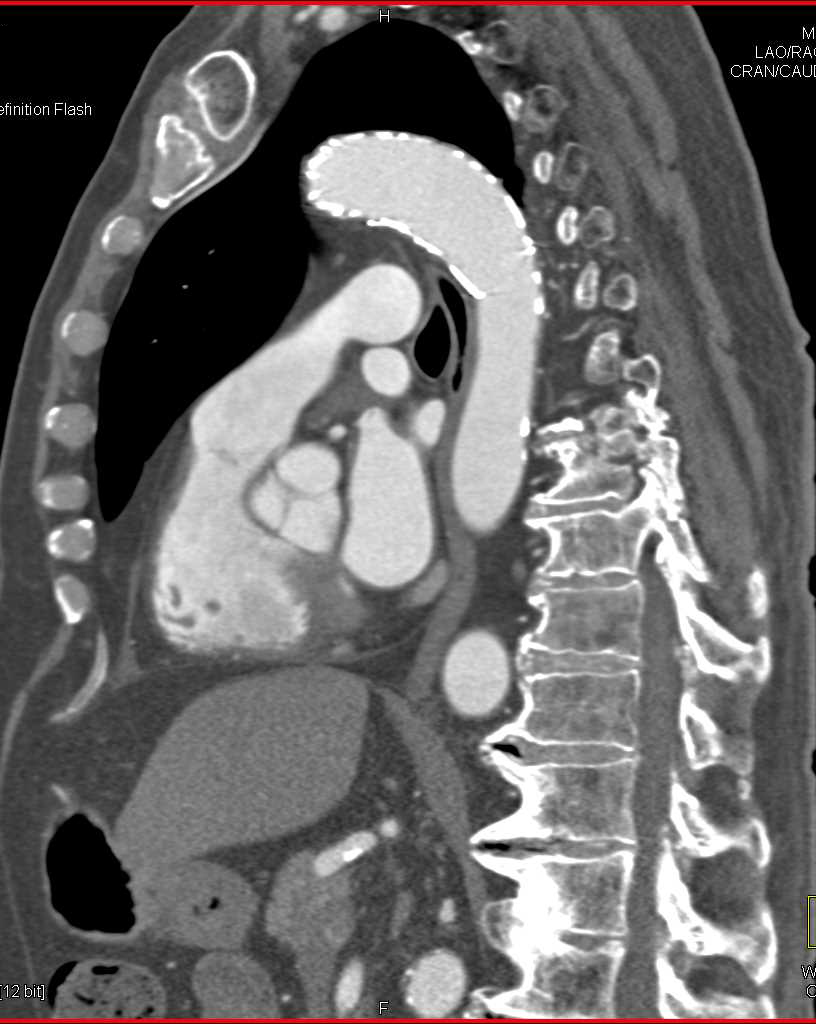 Endovascular Stent Repair in the Arch - CTisus CT Scan