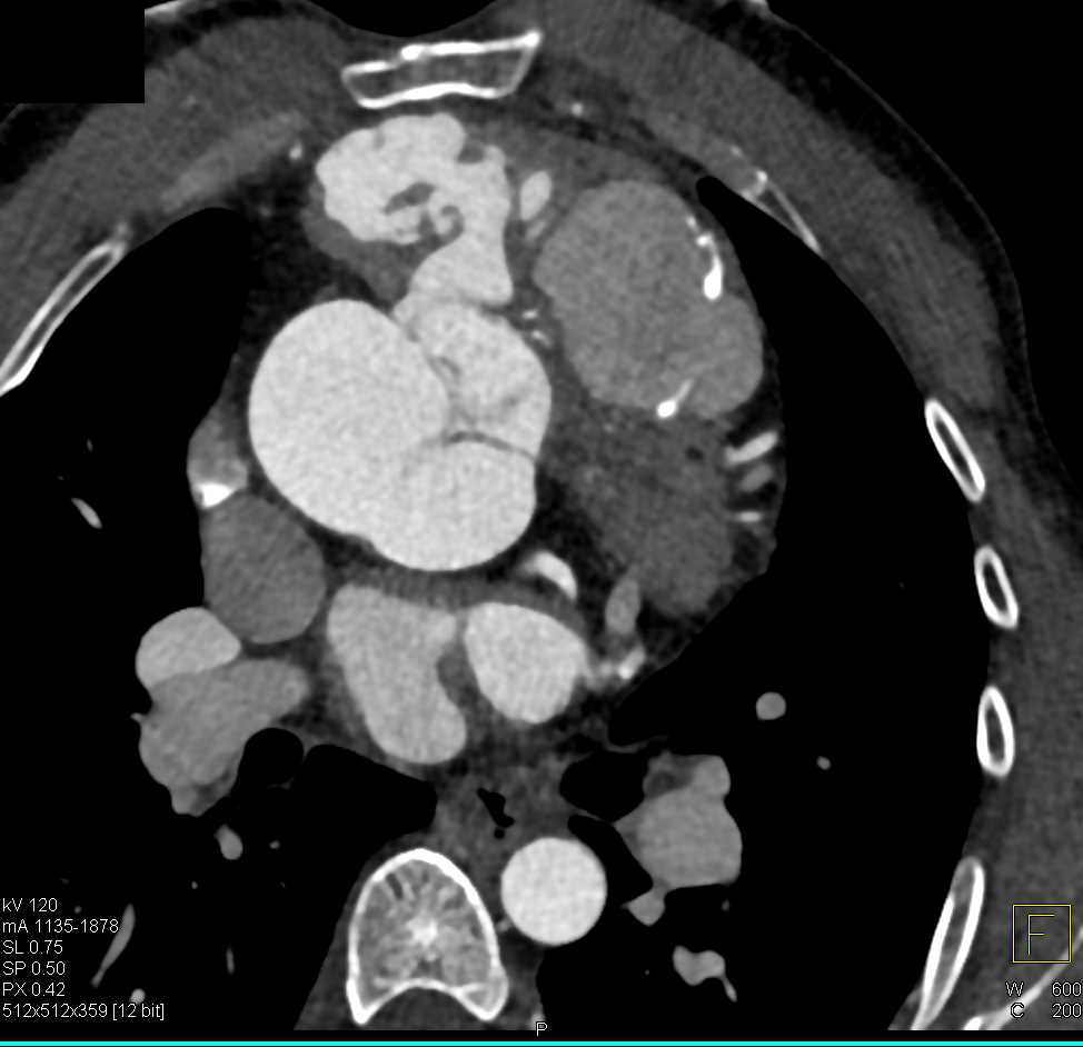 Complex Repair of the Ascending Aorta - CTisus CT Scan