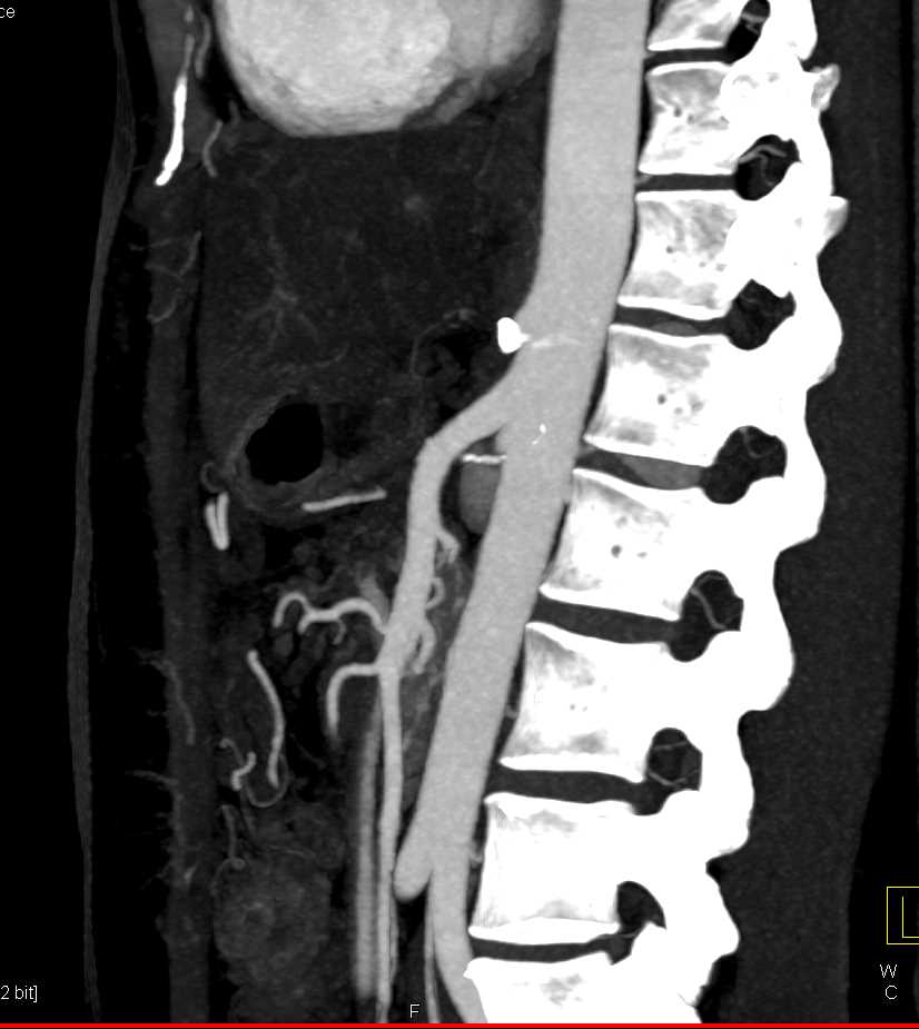 Celiac Artery Occlusion - CTisus CT Scan