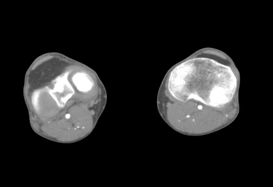 Normal Runoff Lower Extremities - CTisus CT Scan