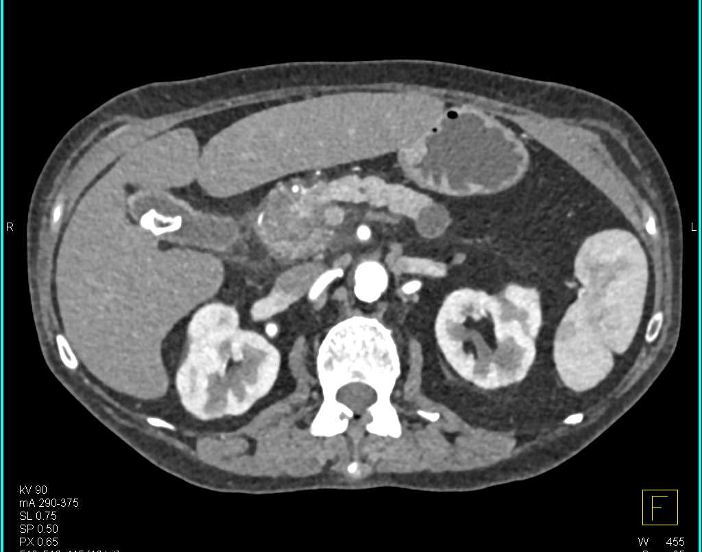 Serous Cystadenoma Head of Pancreas - CTisus CT Scan