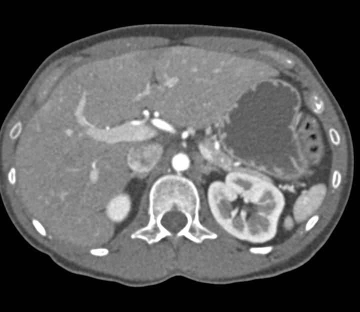 CTA with Automatic Bone Removal Technique - CTisus CT Scan