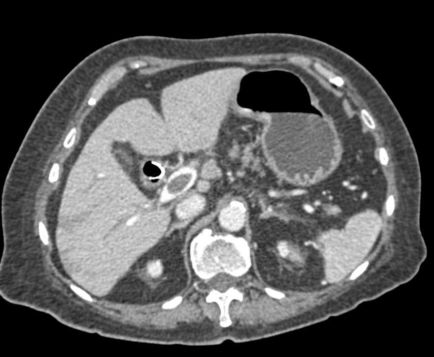 Portal Vein Thrombus with Perfusion Changes Liver - CTisus CT Scan