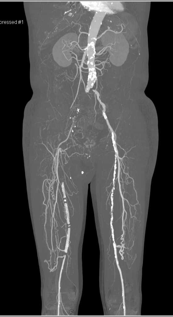 CTA Runoff with Multiple Lesions Including Right Superficial Femoral Artery (SFA) Occlusion - CTisus CT Scan