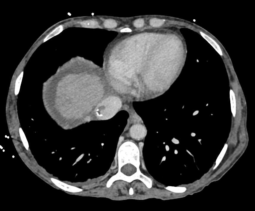 Clot in Inferior Vena Cava (IVC) Near Transjugular Intrahepatic Portosystemic Shunt (TIPS) Catheter - CTisus CT Scan