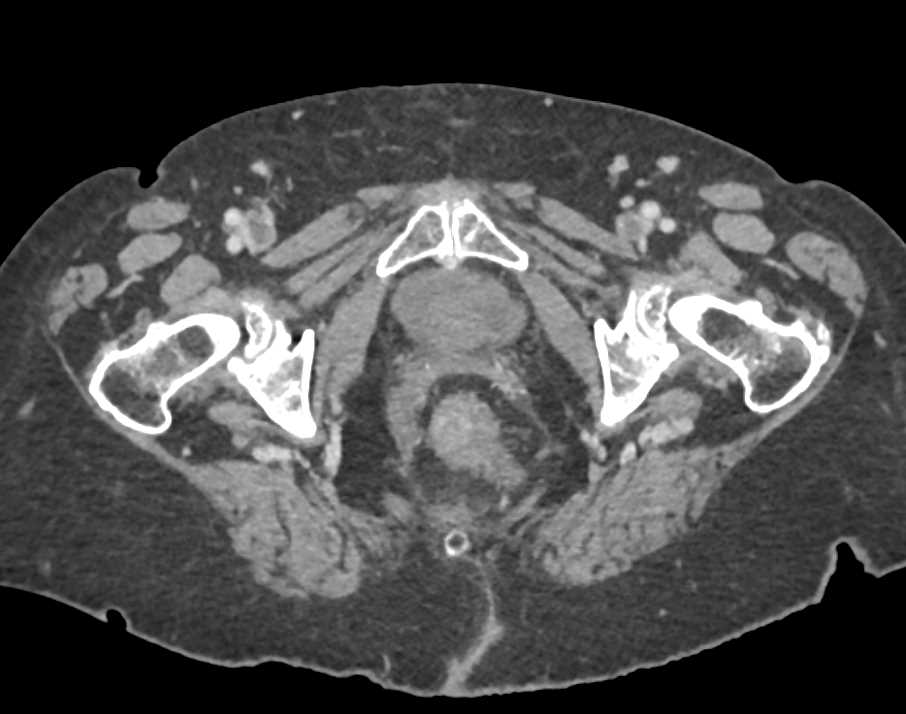 Bilateral Deep Vein Thrombosis (DVT) - CTisus CT Scan