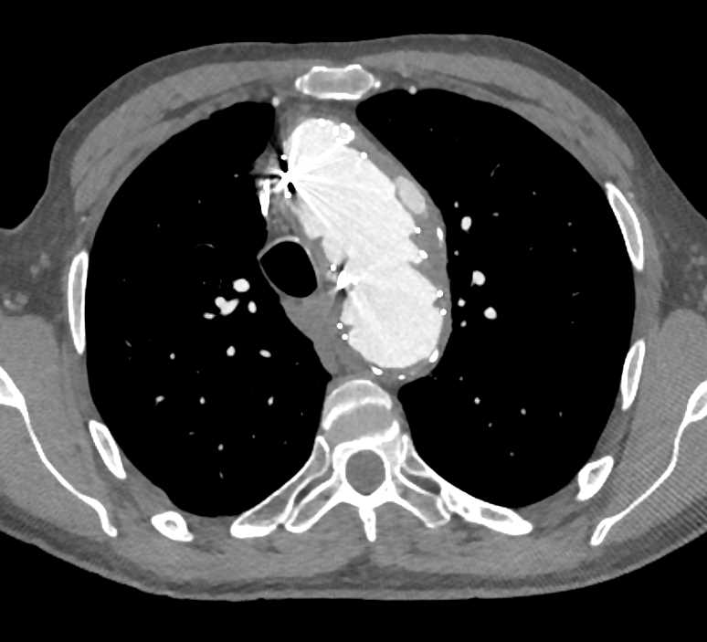 Type 3 Endoleak - CTisus CT Scan