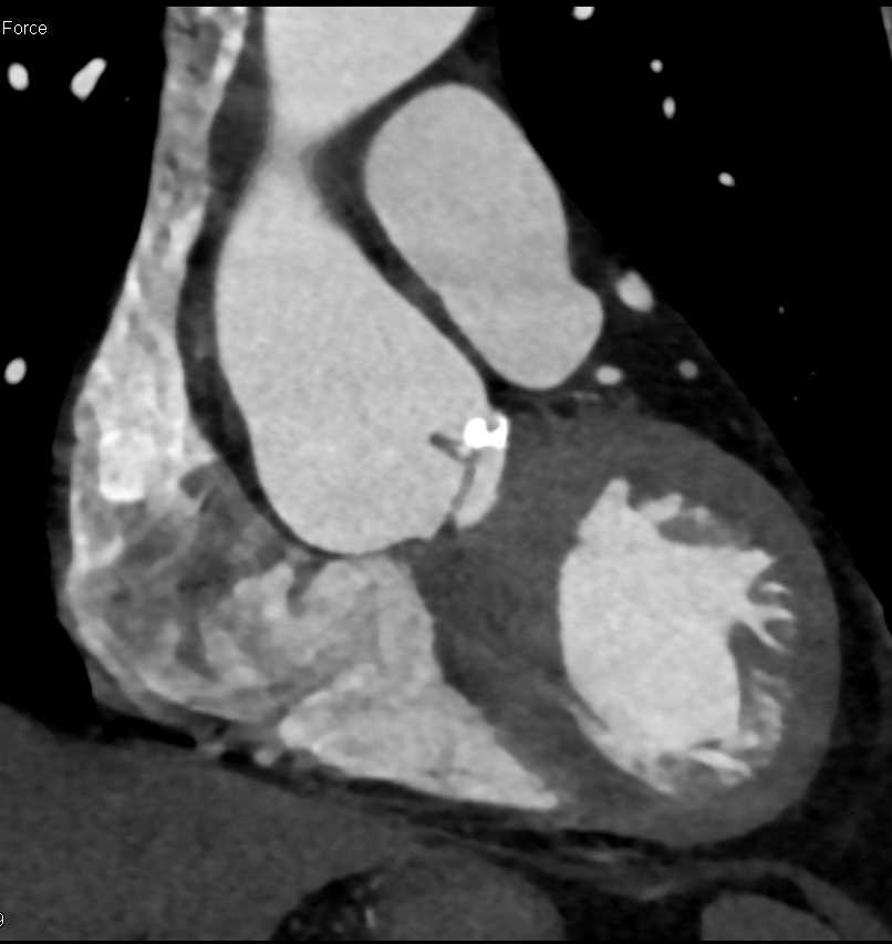 Aortic Valve Calcifications with Dilated Aortic Root - CTisus CT Scan