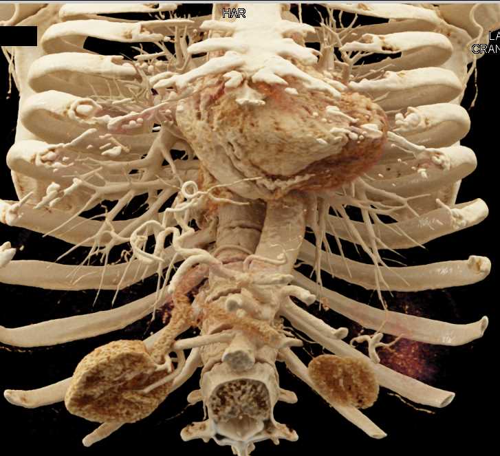 Vascular Mapping with Cinematic Rendering - CTisus CT Scan