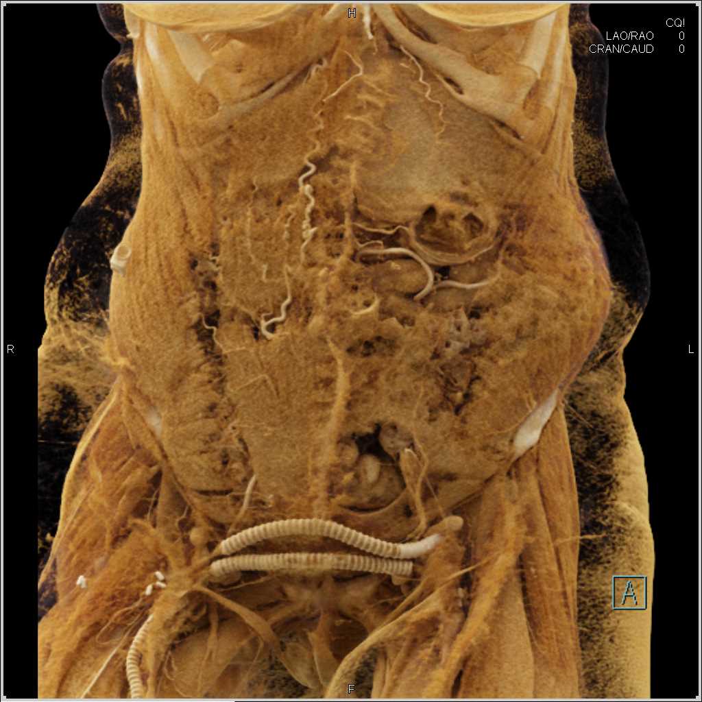 Multiple Failed Vascular Grafts with Cinematic Rendering - CTisus CT Scan