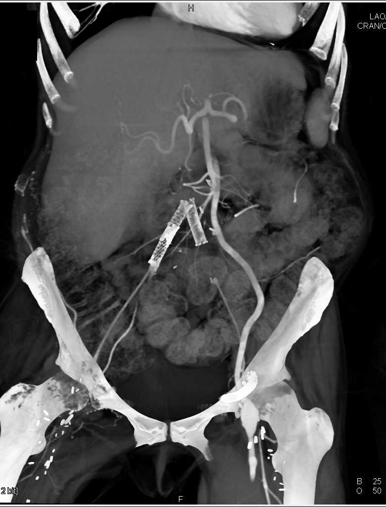 Multiple Failed Vascular Grafts - CTisus CT Scan