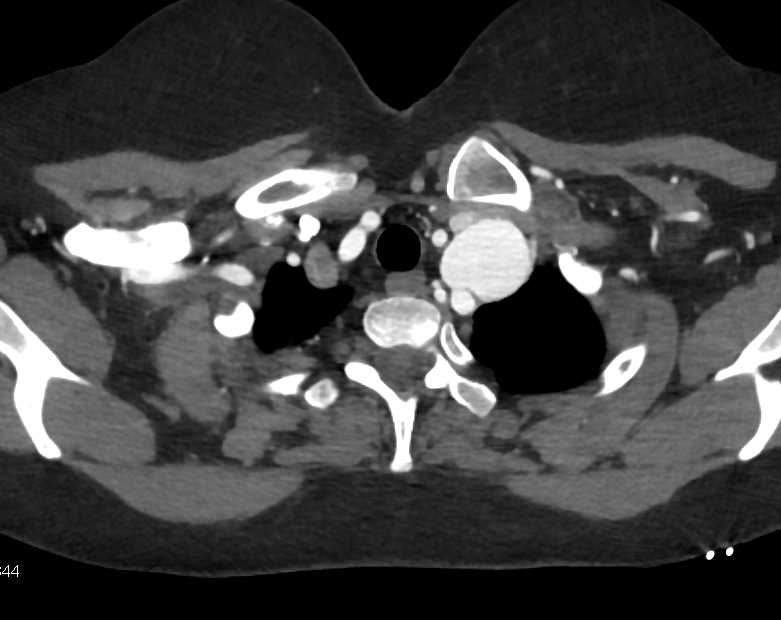 Multiple Aneurysms Incuding Left Subclavian Artery and Hepatic Artery in Patient with Ehlers Danlos Syndrome - CTisus CT Scan