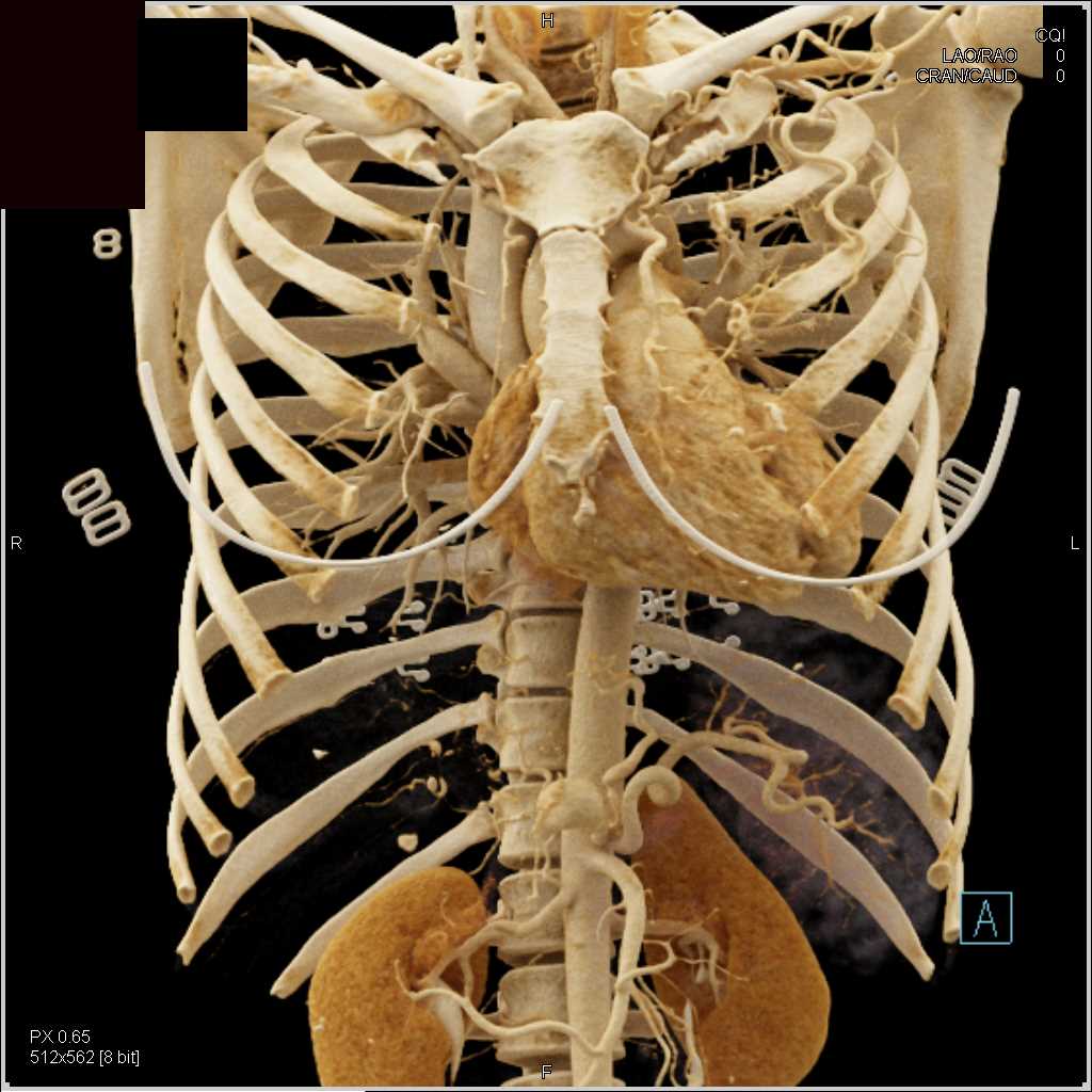 Multiple Aneurysms Incuding Left Subclavian Artery and Hepatic Artery in Patient with Ehlers Danlos Syndrome with Cinematic Rendering - CTisus CT Scan