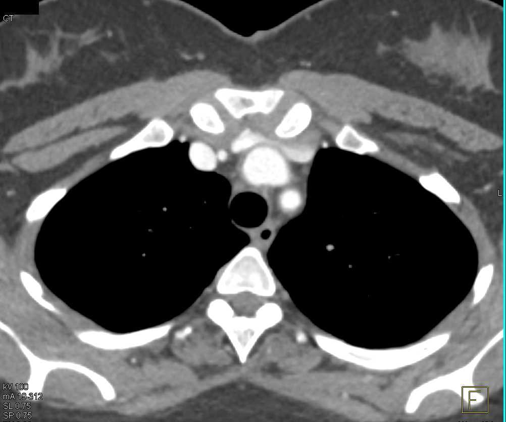 Occlusion Left Subclavian Artery - CTisus CT Scan