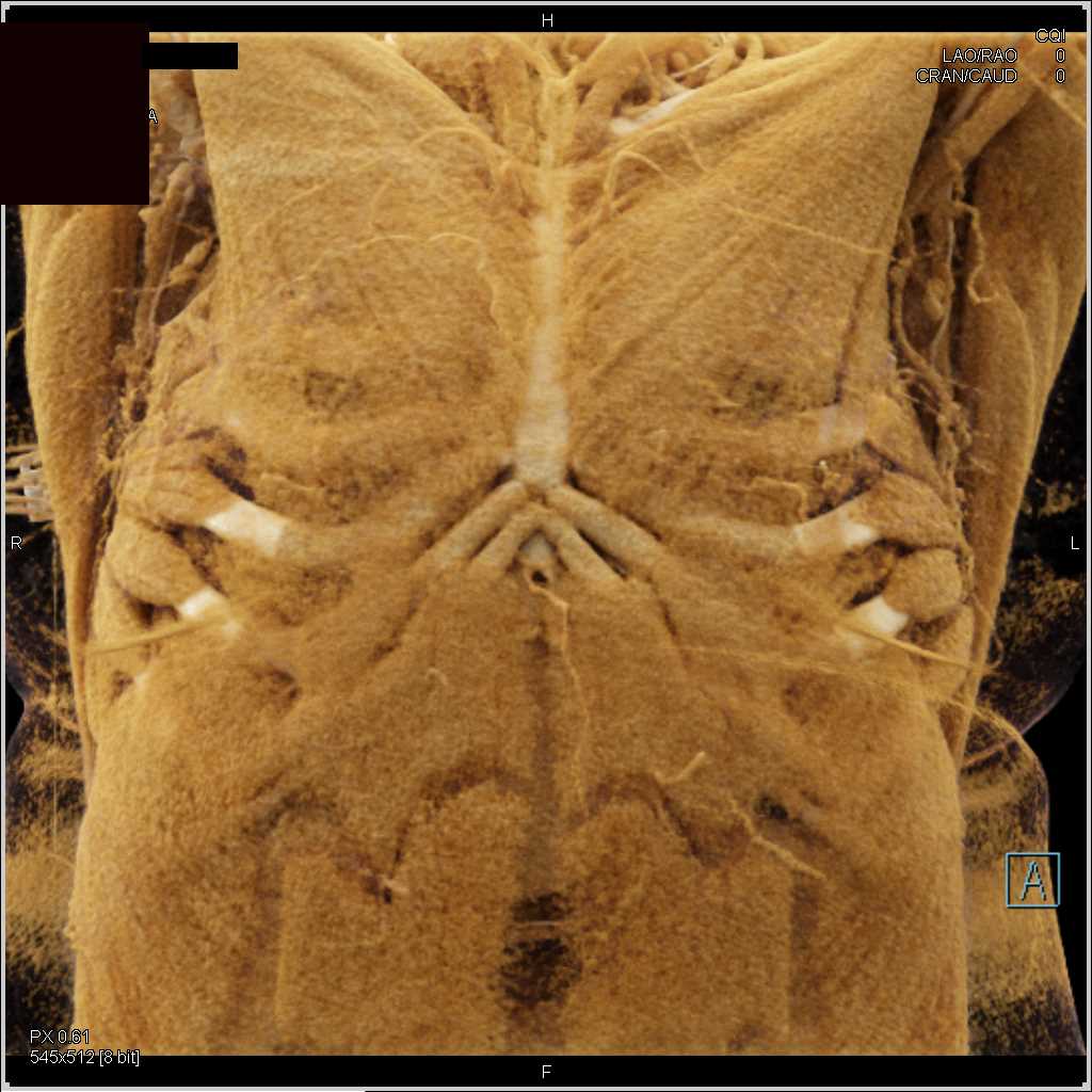 Takayasu's Arteritis with Cinematic Rendering - CTisus CT Scan