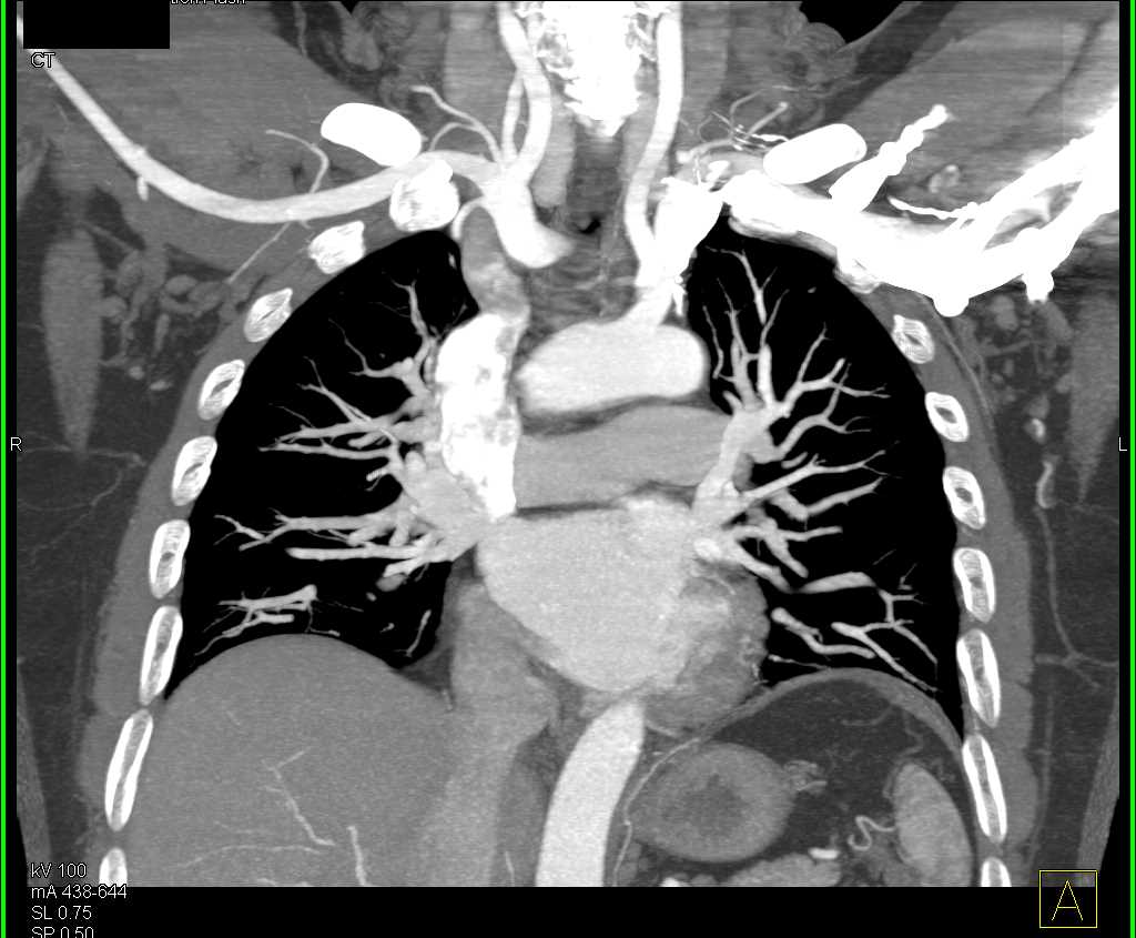 3D Mapping of Right Dorsal Artery off Axillary Artery - CTisus CT Scan