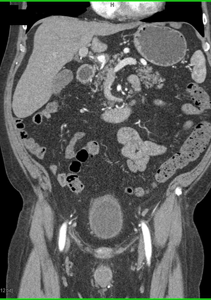 Hepatic Artery Aneurysm - CTisus CT Scan