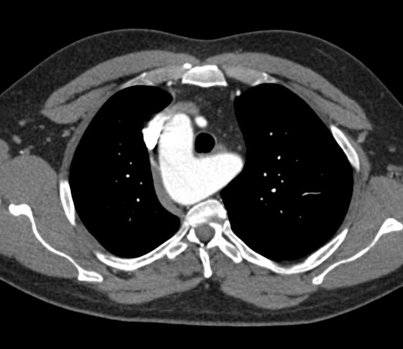 Right Aortic Arch and Celiac Dissection - CTisus CT Scan