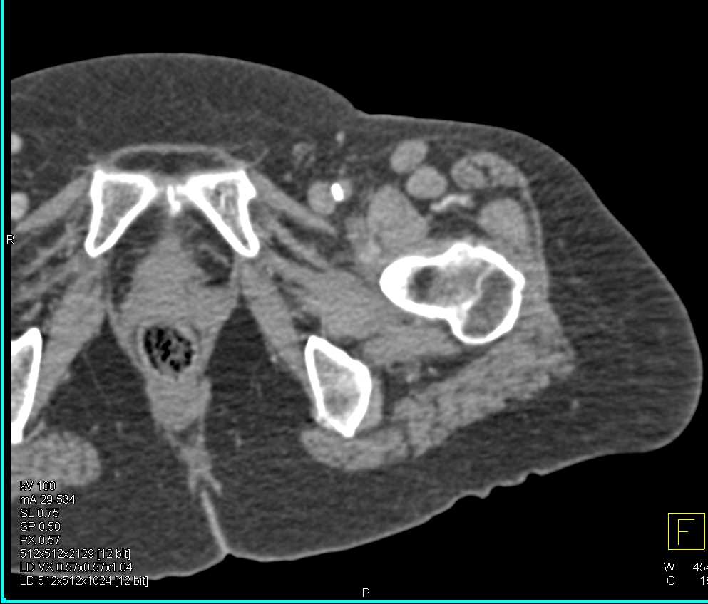 Thrombus in Superficial Femoral Artery - CTisus CT Scan