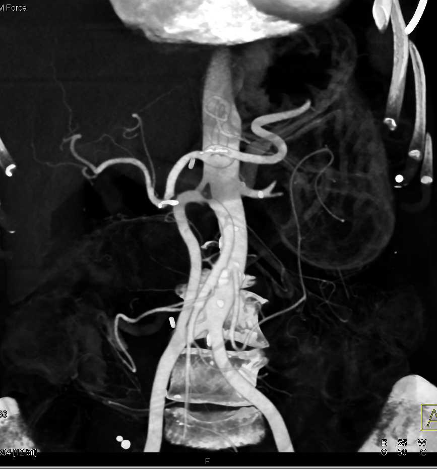 Bypass Graft to Superior Mesenteric Artery (SMA) with High Grade Stenosis - CTisus CT Scan