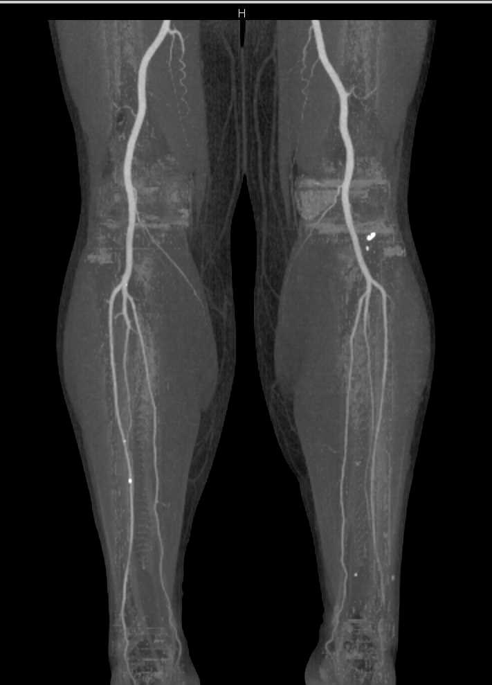 Vascular Planning for Fibular Flap - CTisus CT Scan