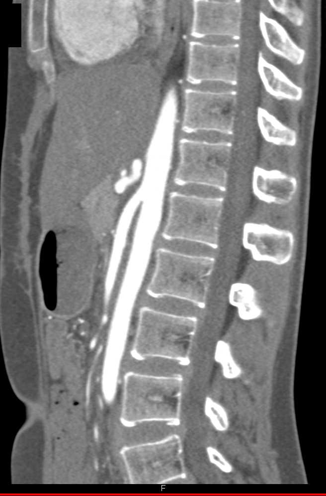 Superior Mesenteric Artery (SMA) Stenosis with SMA Syndrome - CTisus CT Scan