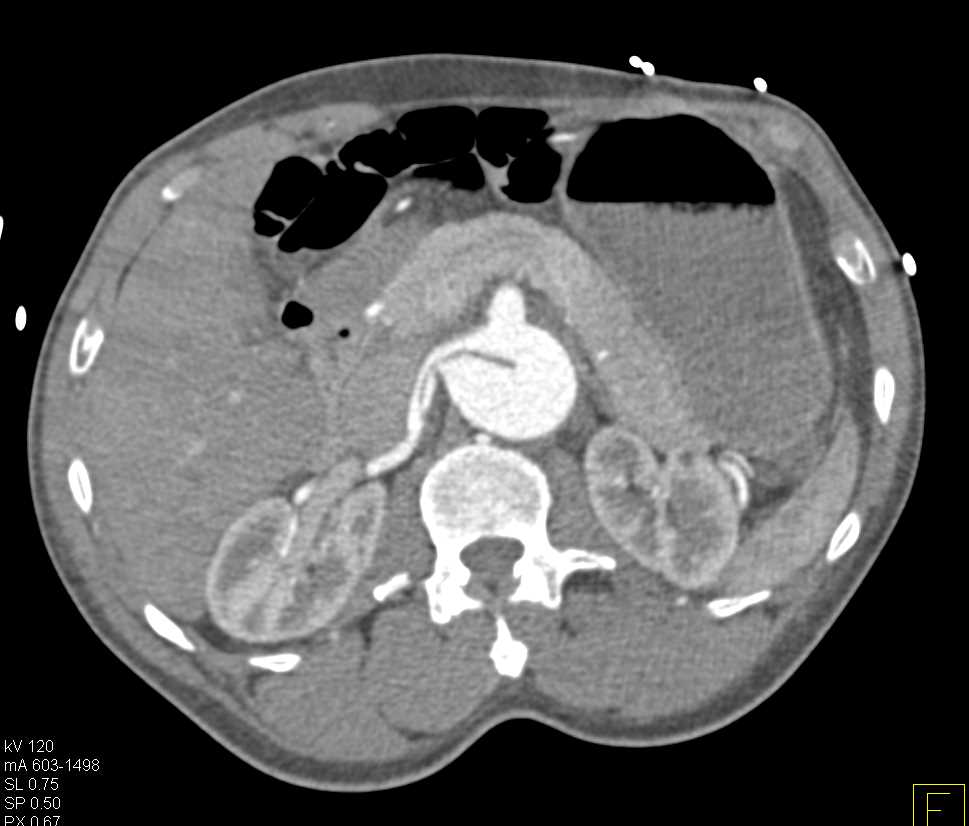 Aortic Dissection Extends into Superior Mesenteric Artery (SMA) and Right Renal Artery - CTisus CT Scan