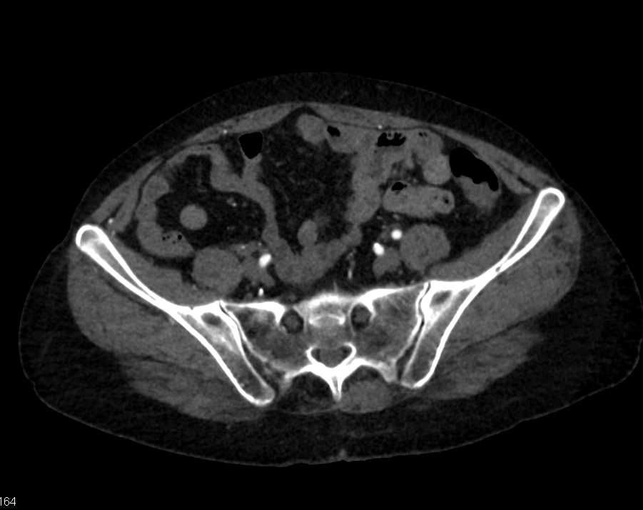 Common Iliac Artery Occlusion on the Right - CTisus CT Scan