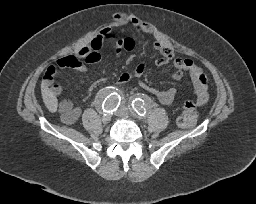 Occluded Left Common Iliac Artery Stent - CTisus CT Scan