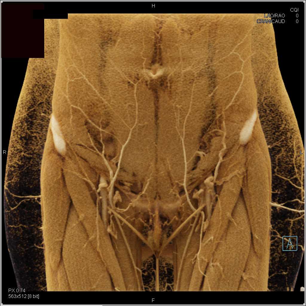 Excellent Visualization of Inferior Epigastric Arteries and Muscle Anatomy with Cinematic Rendering - CTisus CT Scan