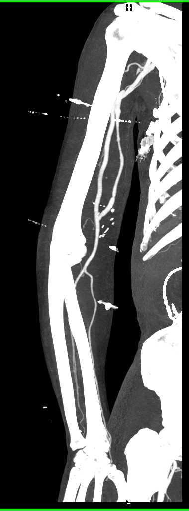 Vascular Graft to Brachial Artery with Stenosis - CTisus CT Scan