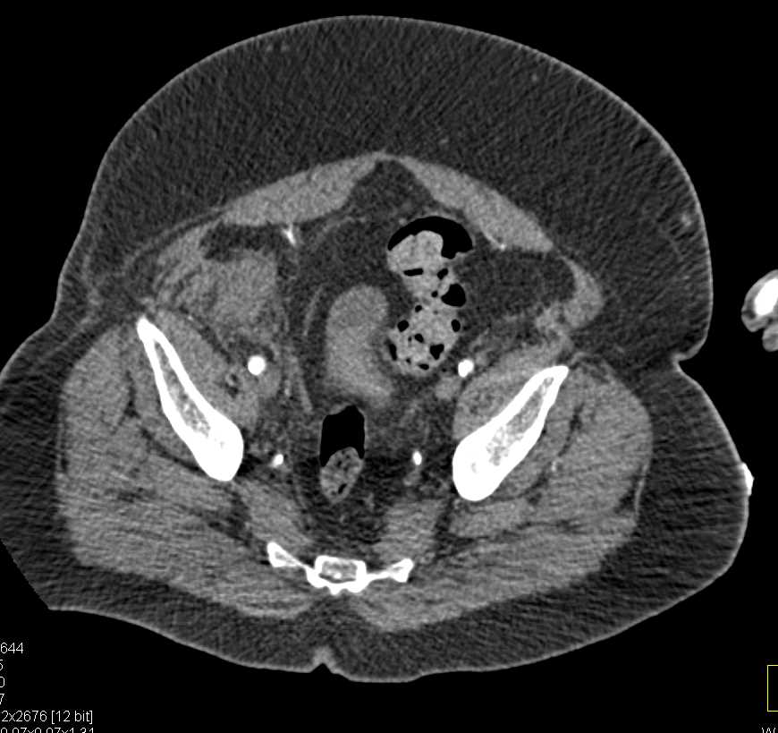 Pseudoaneurysm Right Femoral Artery - CTisus CT Scan