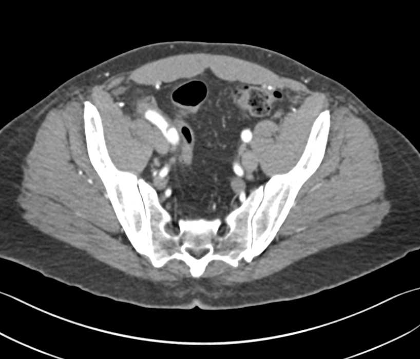 Dissection Right External Iliac Artery - CTisus CT Scan