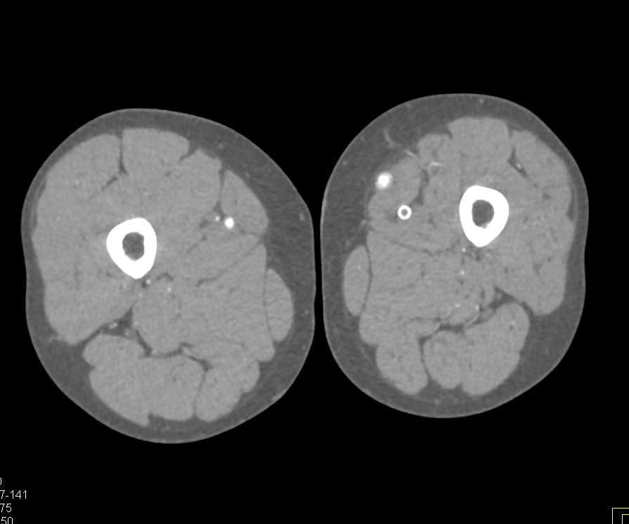 Left Superficial Femoral Artery (SFA) - Popliteal Graft and Failed Stent on the Left Side - CTisus CT Scan