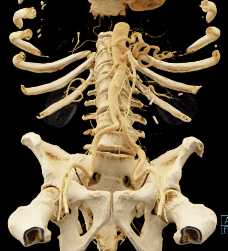 Vascular Mapping for Surgical Planning with Cinematic Rendering - CTisus CT Scan