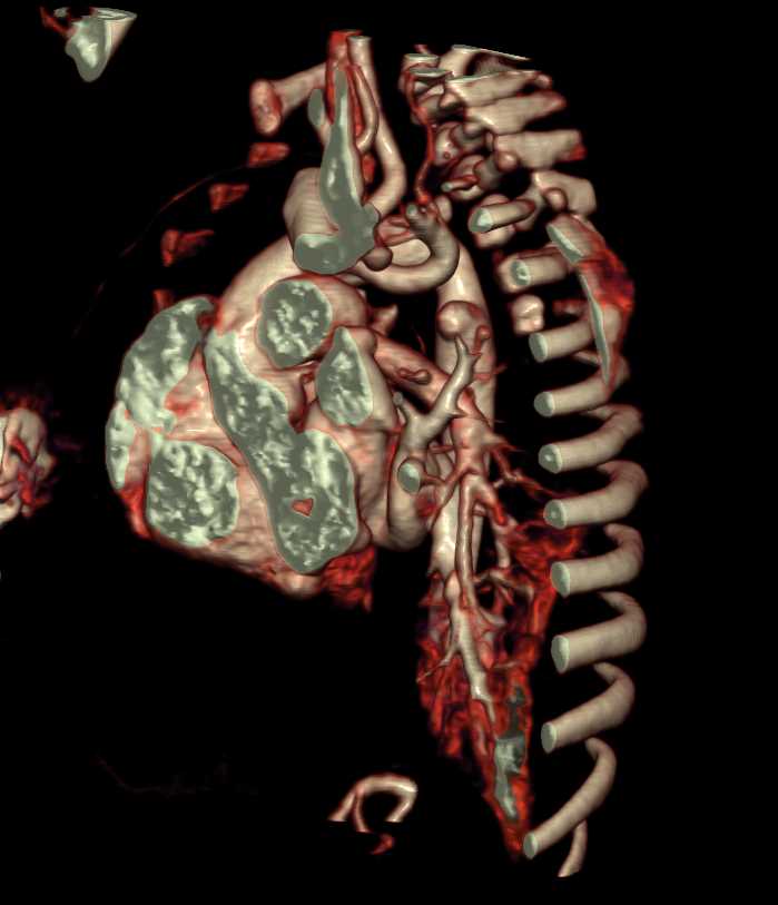 Aortic Ring with Vascular Map - CTisus CT Scan