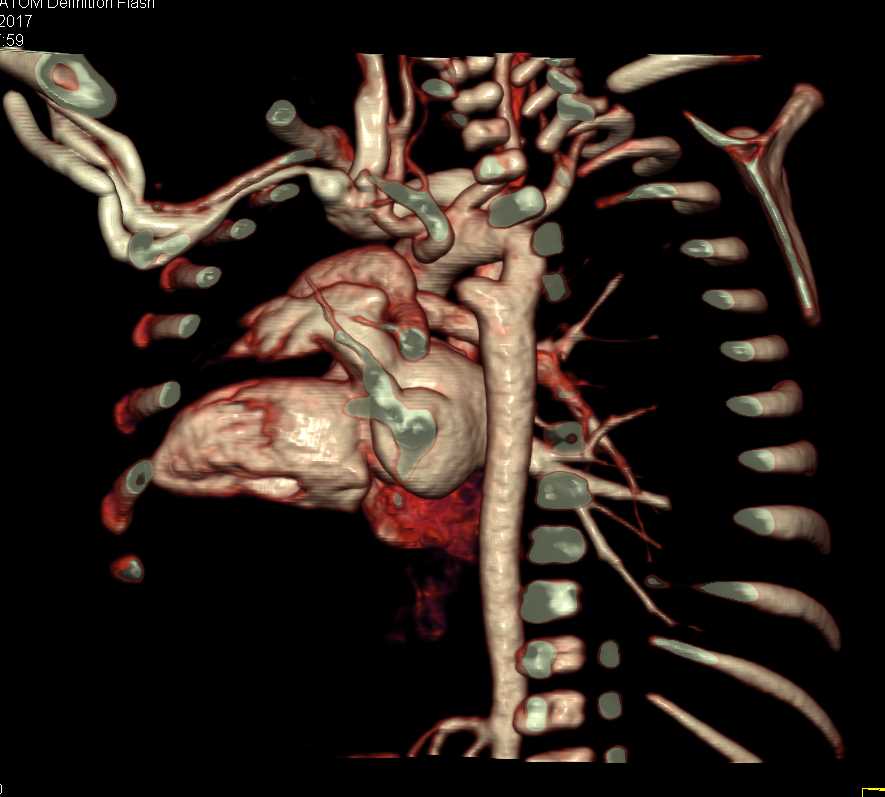 Aortic Ring with Vascular Map - CTisus CT Scan