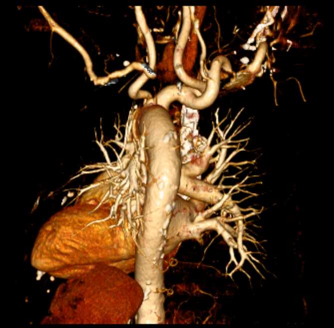 Rib Counting and No Dissection with Cinematic Rendering - CTisus CT Scan