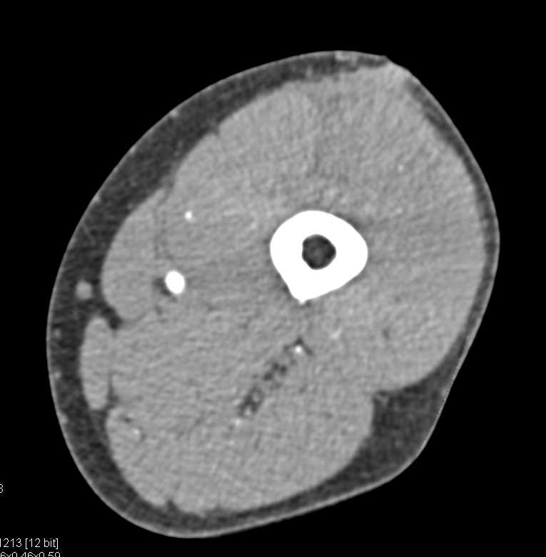Intact Superficial Femoral Artery (SFA) Post Trauma - CTisus CT Scan