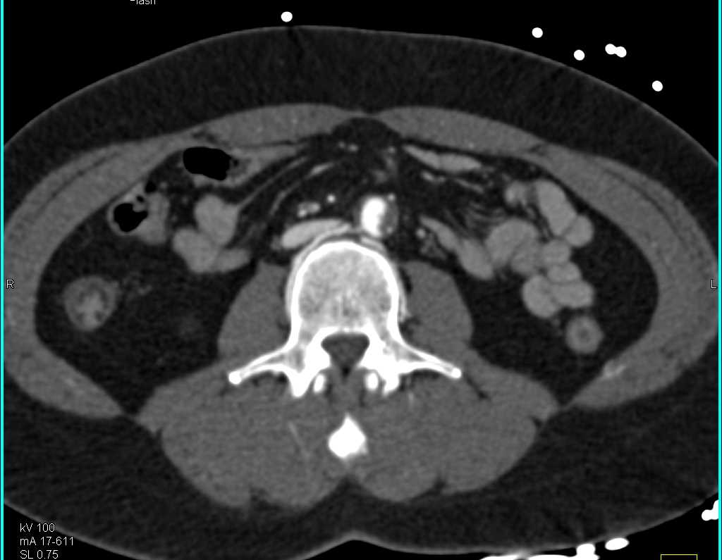 Occlusion of the Right Popliteal Artery in Patient with Clot in Aorta - CTisus CT Scan